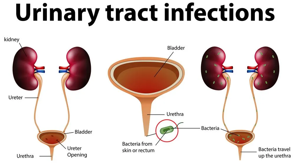 Urinary Tract Infections (UTIs): Risk Factors, Causes and Prevention Guide